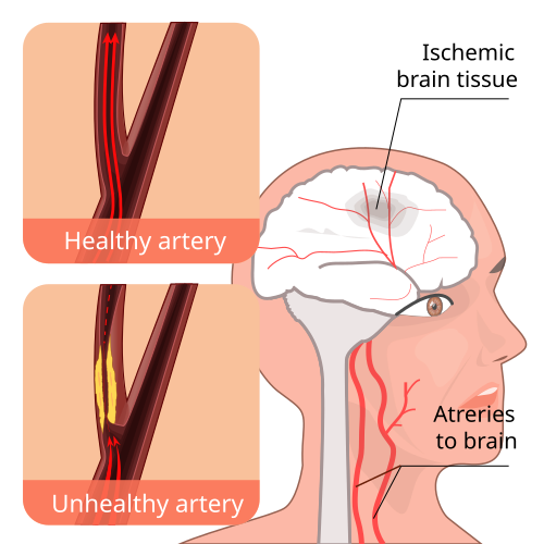 Transient ischemic attack